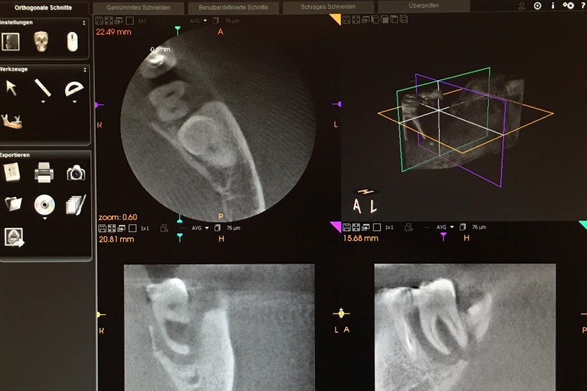 Strahlungsarmes Röntgen, Digitales Röntgen, Röntgen während der Behandlung im Behandlungszimmer, Großröntgen, Panoramaröntgen (OPG), Digitale Volumen Tomographie (DVT), Interorale Kamera, Kommunikationsbildschirme für Visualisierung, Allgemeine Zahnuntersuchung, Plaque anfärben, Beläge anfärben, Speicheldiagnostik, Solingen Remscheid Haan Wuppertal Langenfeld Leichlingen Düsseldorf Dortmund Bochum